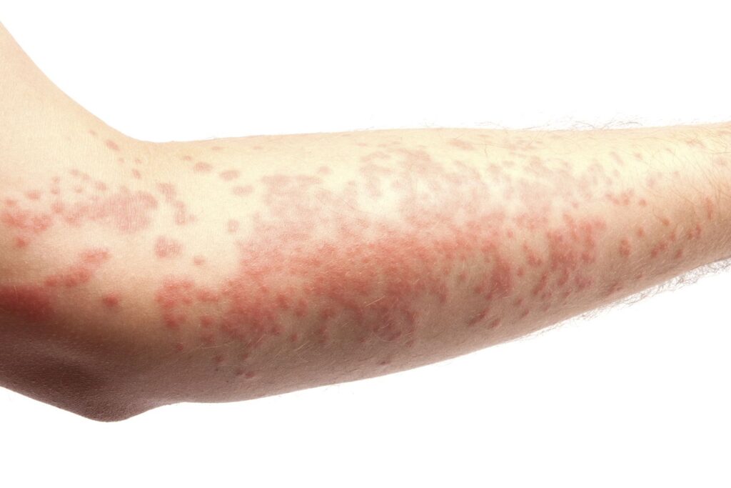 Lamictal Rash: Symptoms, Causes, and Treatment Lamictal Rash: Symptoms, Causes, and Treatment