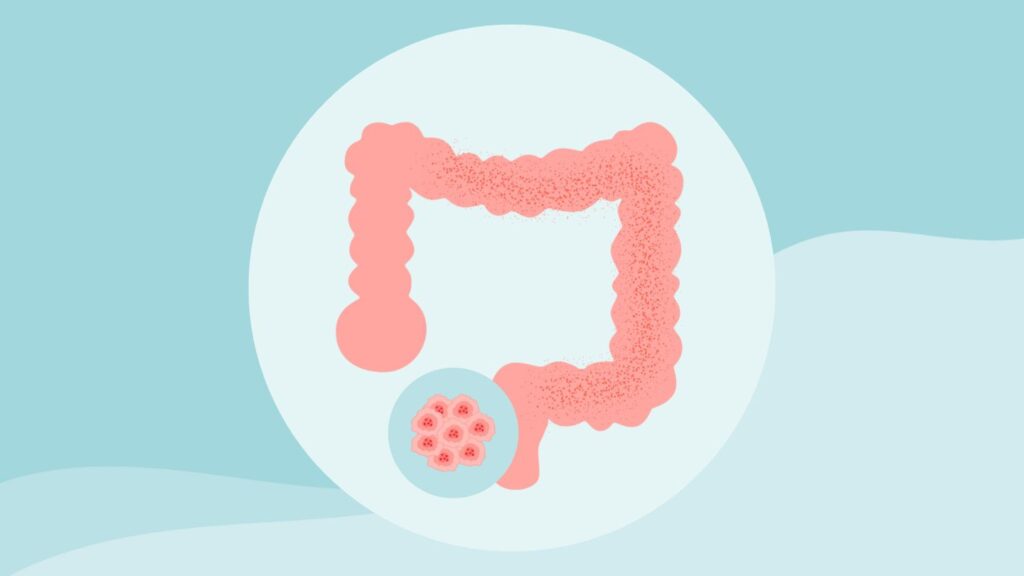 8 Myths About Colon Cancer Debunked