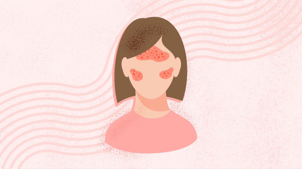 What Is Rosacea? Symptoms, Causes, Diagnosis, Treatment, and Prevention