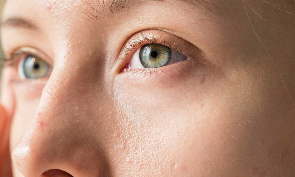 Dry Eye After LASIK or Vision Correction? What To Know Dry Eye After LASIK or Vision Correction? What To Know