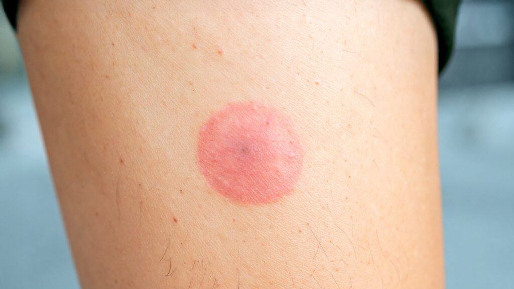 How Do I Know if I’ve Been Bitten by a Tick? 