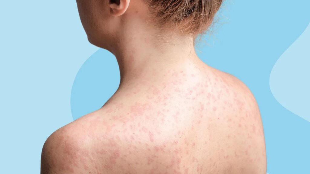 Can I Get Measles if I’m Vaccinated? Can I Get Measles if I’m Vaccinated?