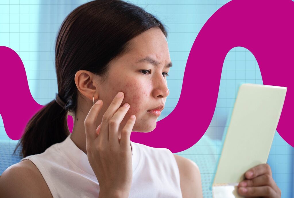 Is Constipation Causing Breakouts? Dermatologists Weigh In